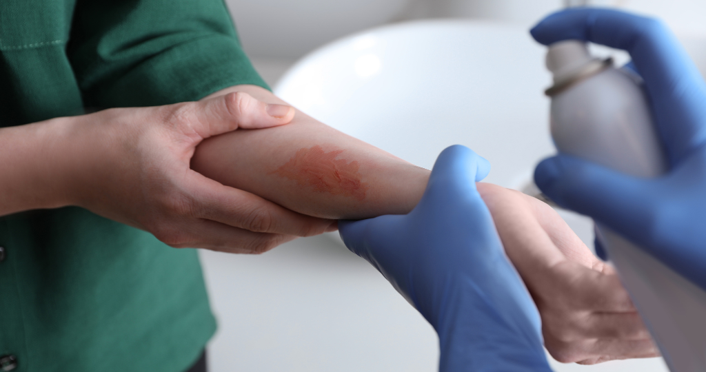 Relief spray on hand
