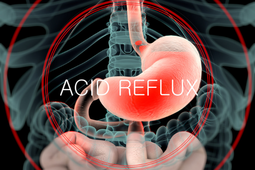 acid reflux